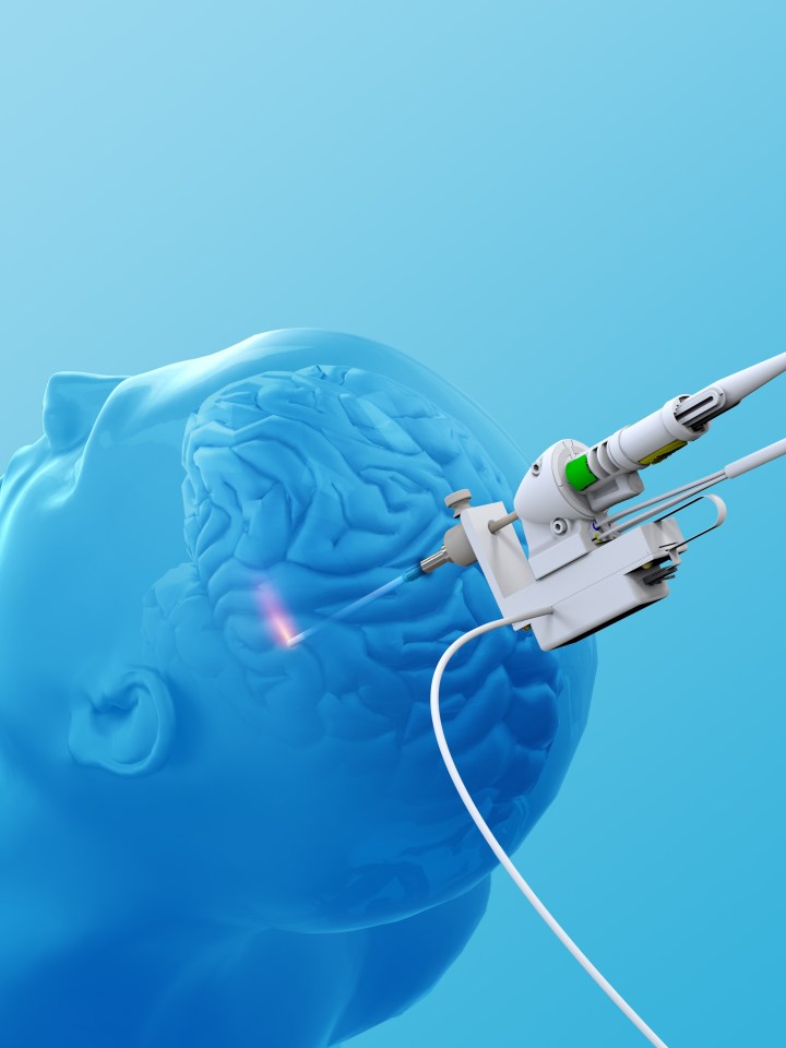 Neuroblate.jpg